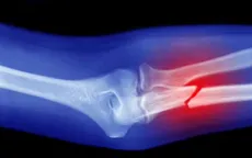 5 lời khuyên của bác sĩ để ngăn ngừa bệnh loãng xương