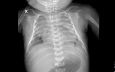 Chậm tiêu dịch phổi - Nguy cơ trẻ sơ sinh phải đối mặt