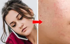 Tại sao mụn thường xuất hiện ở 8 vùng này trên cơ thể?
