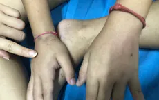 Điều trị thành công cho bé trai bị viêm mao mạch dị ứng nghiêm trọng