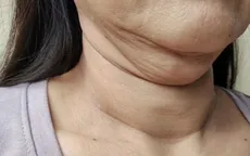 Cách loại bỏ 2 cằm một cách tự nhiên chỉ trong 1 phút