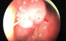 Nam thanh niên 17 tuổi nghi mắc ung thư sau thời gian đau bụng, rối loạn đại tiện