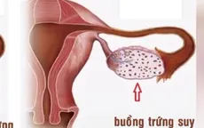 Gia tăng phụ nữ bị suy buồng trứng