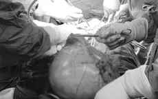Đi khám vì đau bụng, người phụ nữ phát hiện khối u xơ nặng hơn 5kg
