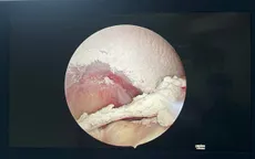 Biến dạng, mất chức năng vận động của khớp do mắc gout nặng