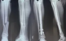Gãy 2 xương cẳng chân sau va chạm khi đá bóng