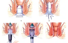 Chảy máu - biến chứng nguy hiểm của bệnh trĩ