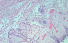 Ca bệnh hiếm gặp: Polyp lông ở trẻ sơ sinh