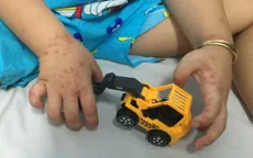 Ca mắc tay chân miệng tiếp tục tăng tại TP. Hồ Chí Minh