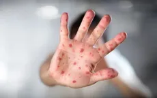 Khu vực phía Nam đã ghi nhận 62 ca bệnh đậu mùa khỉ