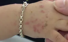 Bệnh tay chân miệng tại Đồng Nai có xu hướng tăng