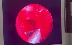 Đi khám vì ngạt mũi, phát hiện u nhú đảo ngược mũi xoang