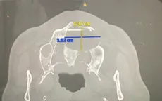 Bóc nang xương hàm gây chảy dịch mũi cho bệnh nhân