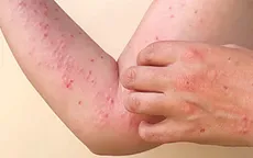 WHO lo ngại nguy cơ lan rộng dịch bệnh đậu mùa khỉ