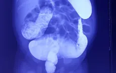 Rối loạn đại tiện, bé 18 tháng phát hiện dị tật bẩm sinh có tỷ lệ tử vong đến 80%