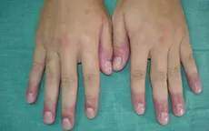 Phòng bệnh cước chân tay mùa lạnh