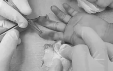 Nối gân ngón tay đứt rời cho bé gái bị tai nạn sinh hoạt