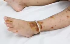 Cảnh giác bệnh thủy đậu hoại thư, đe dọa tính mạng