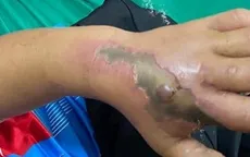 Bé trai bị hoại tử bàn tay nghi do rắn độc cắn