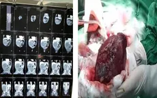 Phẫu thuật u thận ác tính cho bé trai 1 tuổi