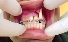 Tỉ lệ biến chứng niềng răng tăng cao, nguyên nhân do đâu?