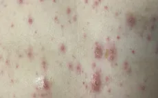 Một huyện ở Hà Nội ghi nhận gần 250 ca mắc thủy đậu