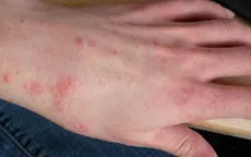 Quảng Ngãi: Xử lý bệnh ghẻ đang lây lan trong thôn có đông đồng bào dân tộc Cor