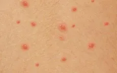 Số ca thủy đậu ở Hà Nội tăng
