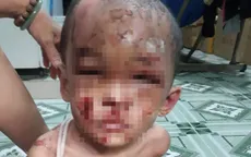 Bé trai 1 tuổi người đầy vết thương, vết bỏng, nghi bị cha mẹ bạo hành