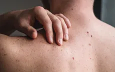 Vaccine ung thư thử nghiệm kết hợp liệu pháp miễn dịch có thể ngăn khối u ác tính phát triển