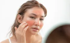 Liệu chứng bỏng gió có thực sự vô hại như bạn nghĩ?