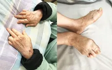 Biến dạng khớp bàn tay, bàn chân do viêm khớp dạng thấp