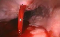 Cứu bệnh nhi 15 tuổi nôn ra máu do ổ loét dạ dày