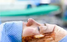 Những biến chứng của trào lưu nâng mũi cấu trúc