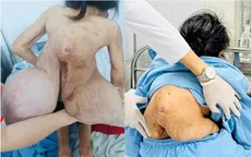 Hai lần phẫu thuật cắt bỏ khối u khổng lồ cho bệnh nhân
