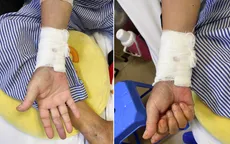 Suýt phải cắt cụt bàn tay do tắc động mạch