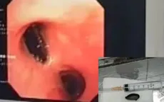 Nhập viện vì khó thở, đau tức ngực, bác sĩ phát hiện "thủ phạm" là hạt hồng xiêm nằm chắn ngang lòng phế quản