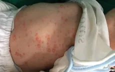 Lây thủy đậu từ mẹ, bé sơ sinh bị biến chứng nặng