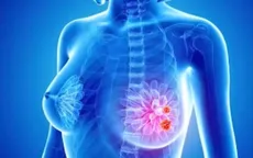 Nữ giới nên sớm tầm soát ung thư vú từ năm 40 tuổi