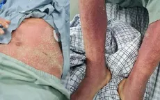 Triển khai các hoạt động điều tra, giám sát, phòng chống bệnh liên cầu lợn trên người