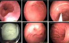 Gắp chiếc tăm dài gần 7cm găm sâu vào dạ dày bệnh nhân