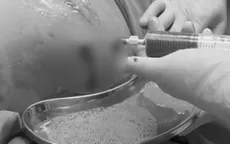 Hút 1,5 lít dịch mủ cứu bệnh nhân thoát nguy kịch do áp xe gan