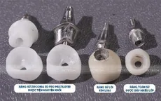 Tại sao răng sứ Zirconia 3D Pro Multilayer hiệu quả trong phục hình implant?