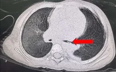 Bé gái viêm phổi nặng do miếng thịt "bỏ quên" trong đường thở