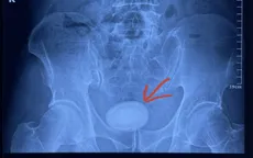 Người đàn ông có viên sỏi kích thước 6cm trong bàng quang
