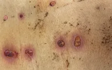 Nguy hiểm tiềm ẩn khi điều trị y học cổ truyền tại các cơ sở không có chuyên môn