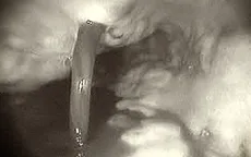 Bé trai xuất huyết tiêu hoá do thói quen ăn cay, uống nước có ga