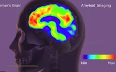 Thuốc Donanemab làm chậm sự tiến triển của bệnh Alzheimer