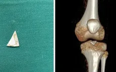 Lấy mảnh sành sắc nhọn bị "bỏ quên" 2 năm trong khớp gối bé 9 tuổi