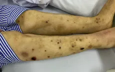 Mời thầy lang dùng ong châm trị đau chân tay, bệnh nhân đái tháo đường phải nhập viện vì đa biến chứng